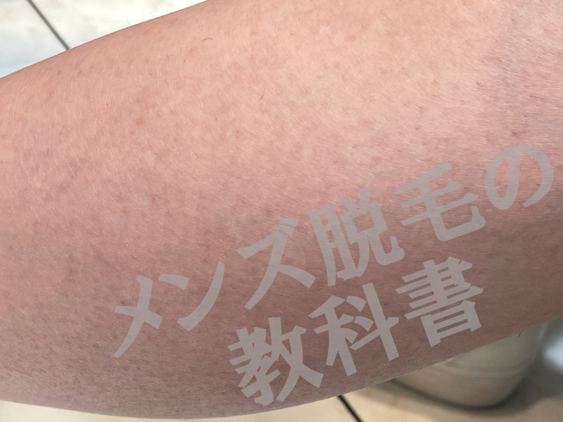 メンズミュゼ新宿西口店でひざ下（スネ毛）脱毛を体験したプロテインさん・２６歳・埼玉県の脱毛部位写真