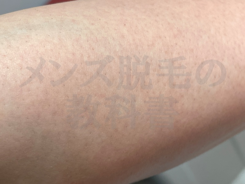  メンズミュゼ錦糸町店で腕脱毛を実施したＲさん（２５歳・千葉県）の施術部位拡大写真