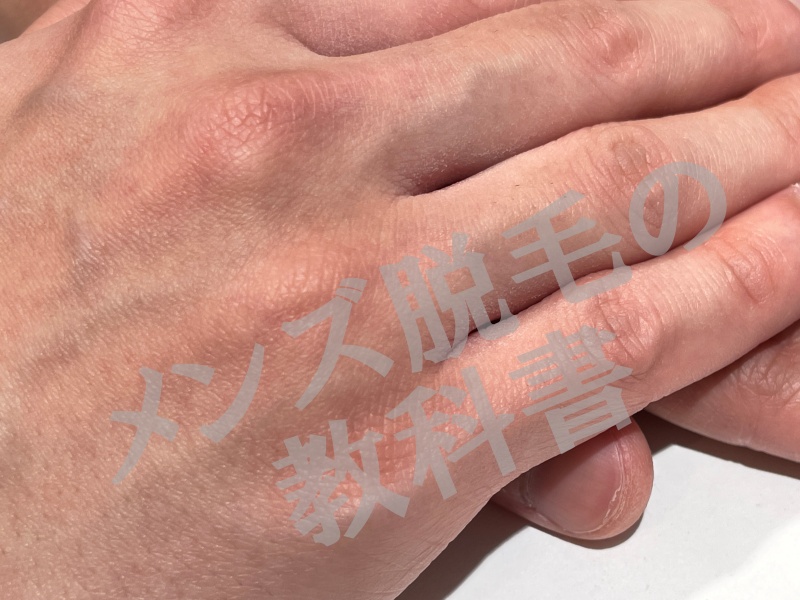 メンズミュゼ新宿西口店で手の甲・指脱毛を体験したプロテインさん・２６歳・埼玉県の脱毛部位写真